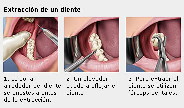 extraccion de un diente