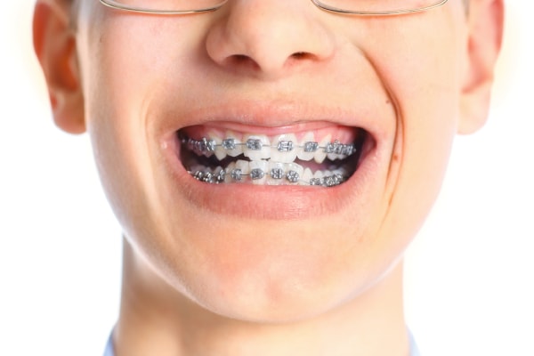 Niño con ortodoncia y brackets