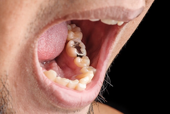 Dientes en mal estado